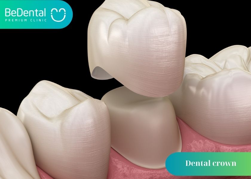 Should You Get a Dental Crown After Tooth Fillings?