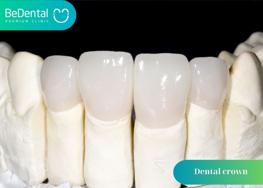 Should You Get a Dental Crown After Tooth Fillings?