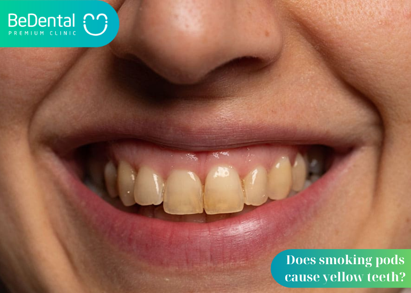 Does smoking pods cause yellow teeth?