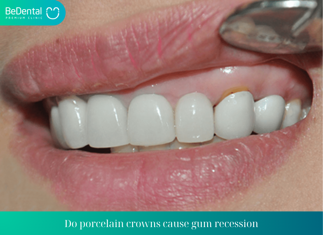 Do porcelain crowns cause gum recession