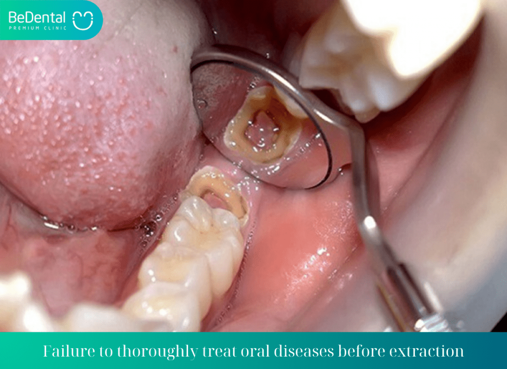 Failure to thoroughly treat oral diseases before extraction