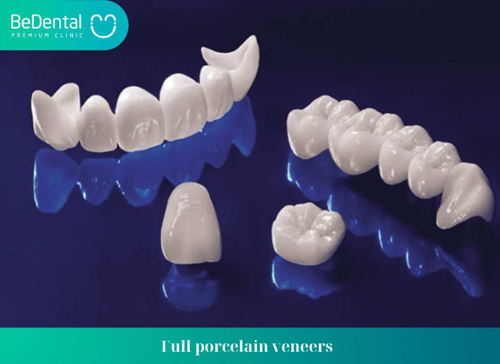 Full porcelain veneers