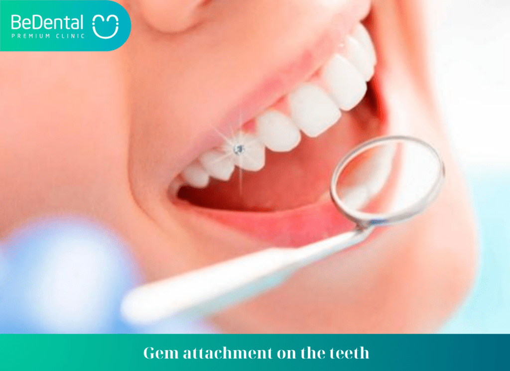 Gem attachment on the teeth