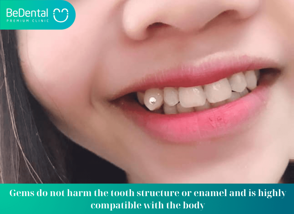 Gems do not harm the tooth structure or enamel and is highly compatible with the body