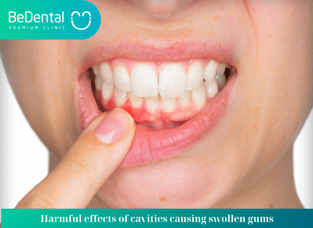 cavities causing swollen gums