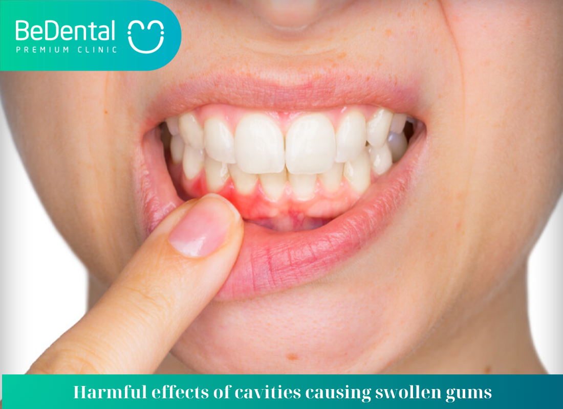 Harmful effects of cavities causing swollen gums