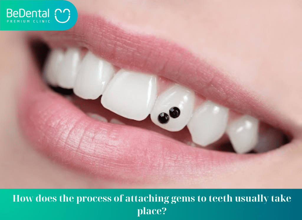 How does the process of attaching gems to teeth usually take place