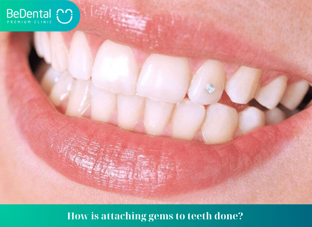 How to Attach Gems to Teeth