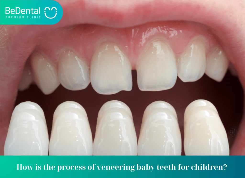 How is the process of veneering baby teeth for children