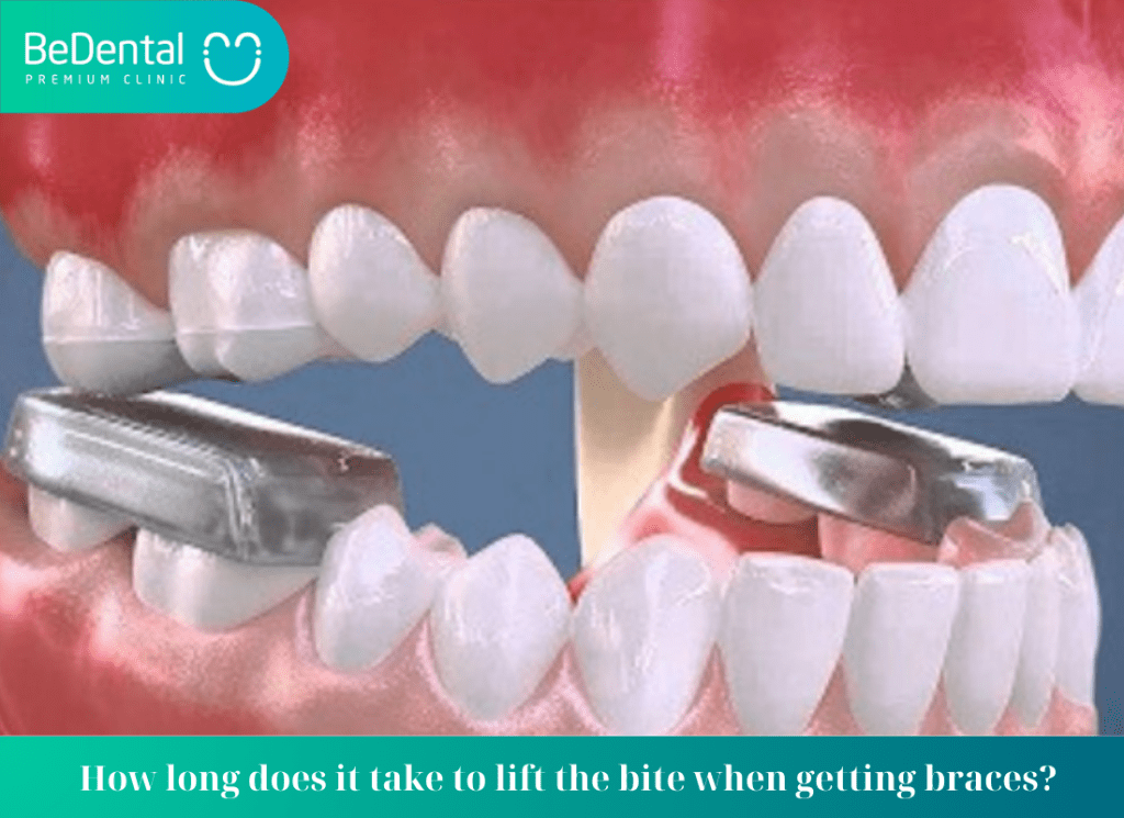 How long does it take to lift the bite when getting braces