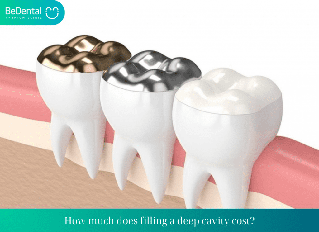 How much does filling a cavity cost