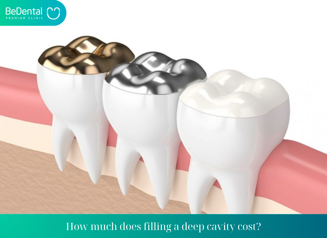 How much does filling a deep cavity cost