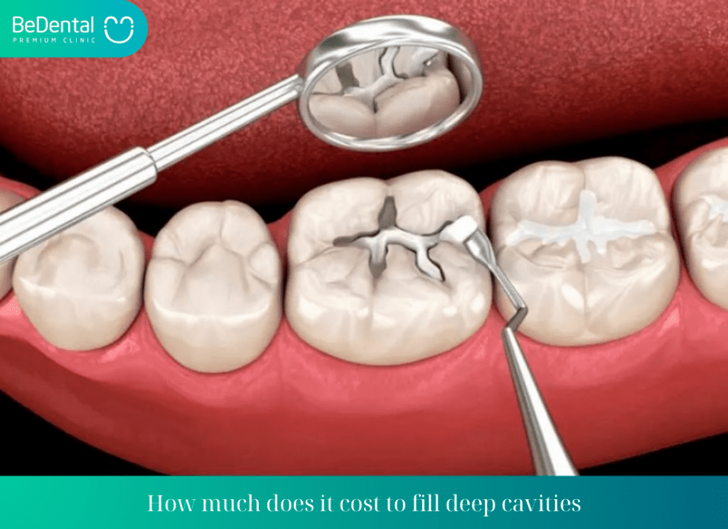 How much does it cost to fill a large cavity