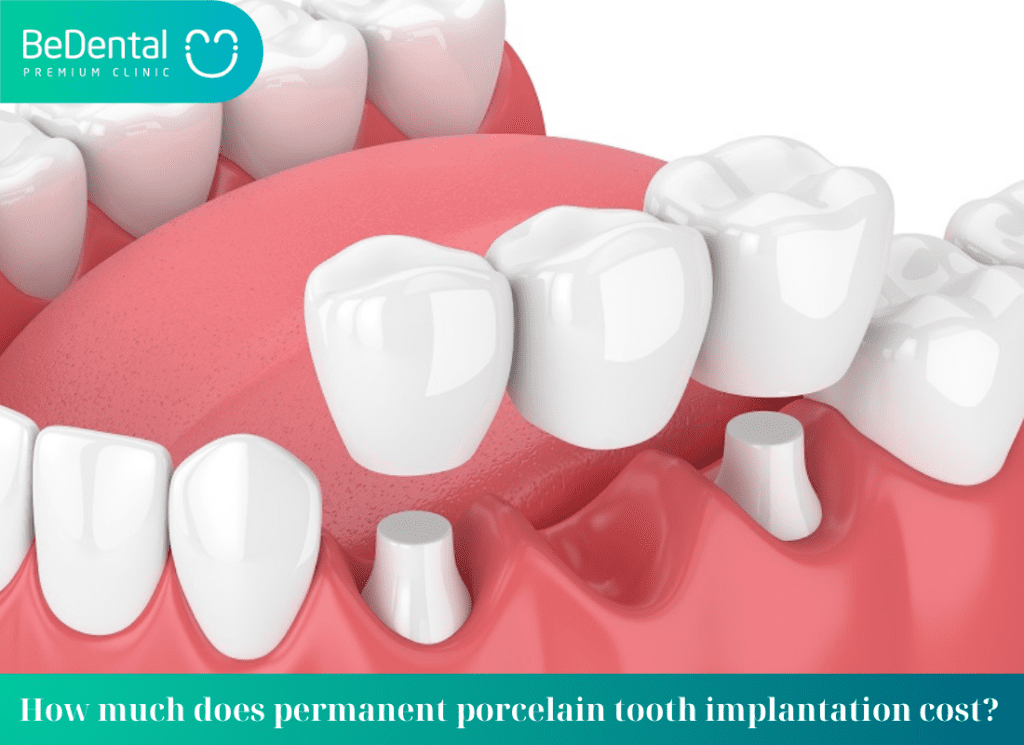 How much is a permanent porcelain tooth implant