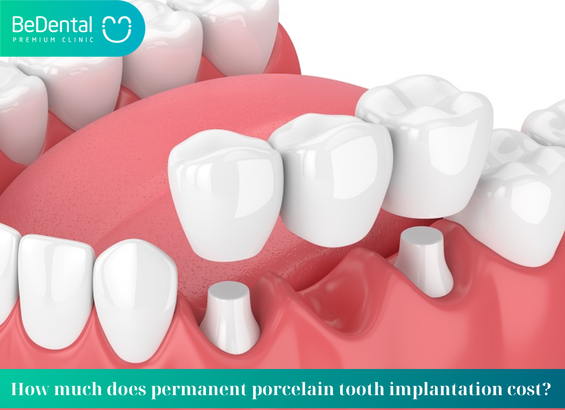 How much does permanent porcelain tooth implantation cost