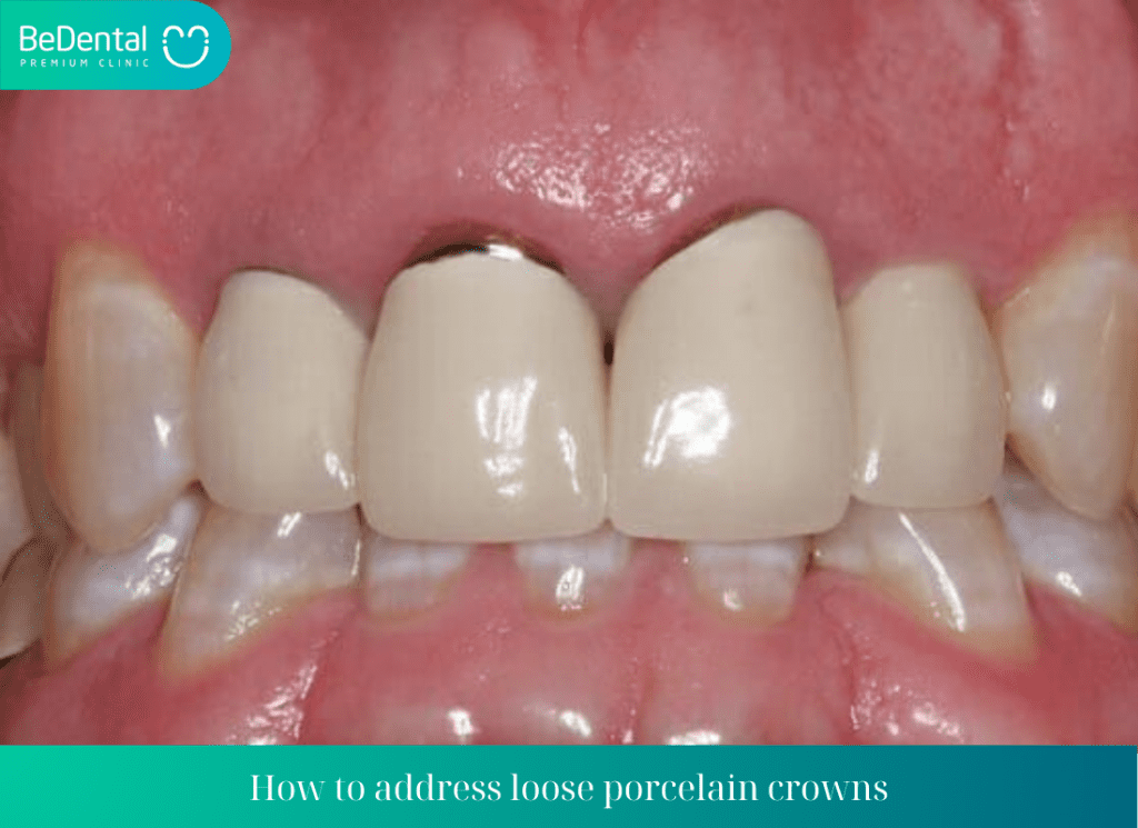 How to address loose porcelain crowns