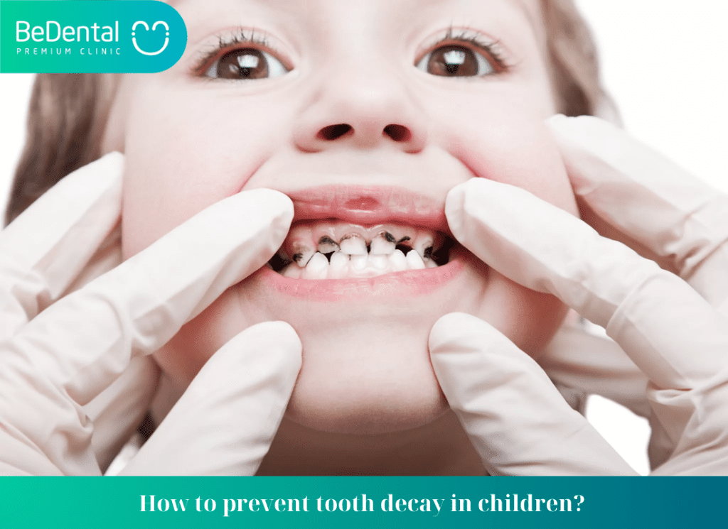 What is tooth decay and how to prevent tooth decay in children