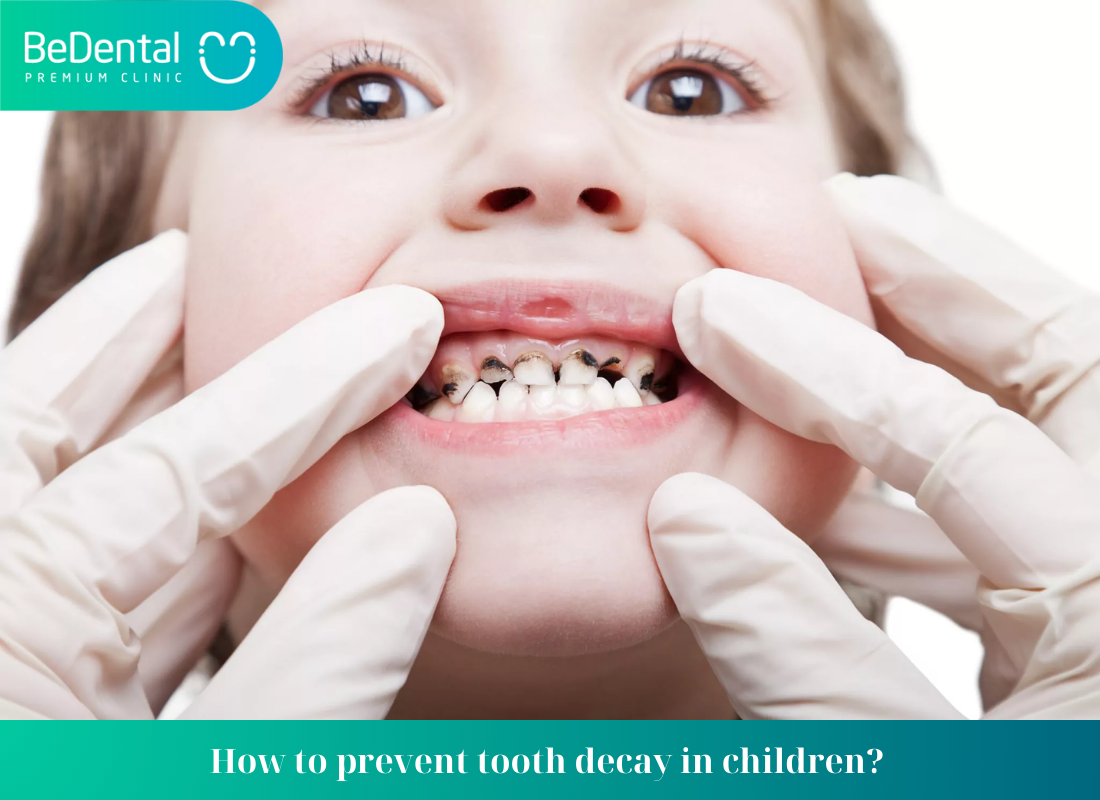 How to prevent tooth decay in children