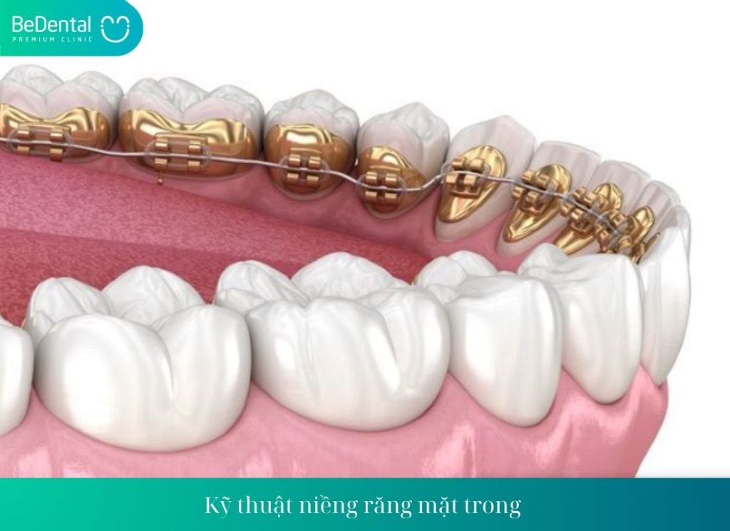 Niềng răng mắc cài mặt trong có hiệu quả không?