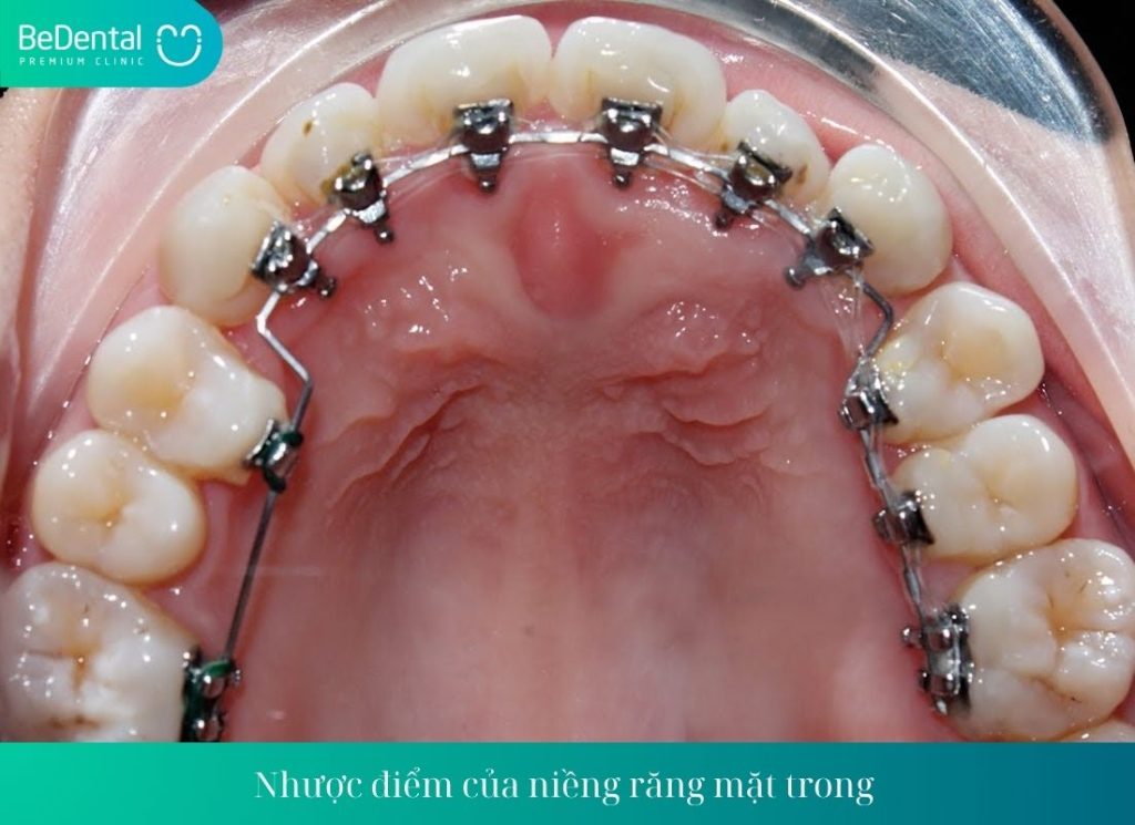 Niềng răng mắc cài mặt trong có hiệu quả không?