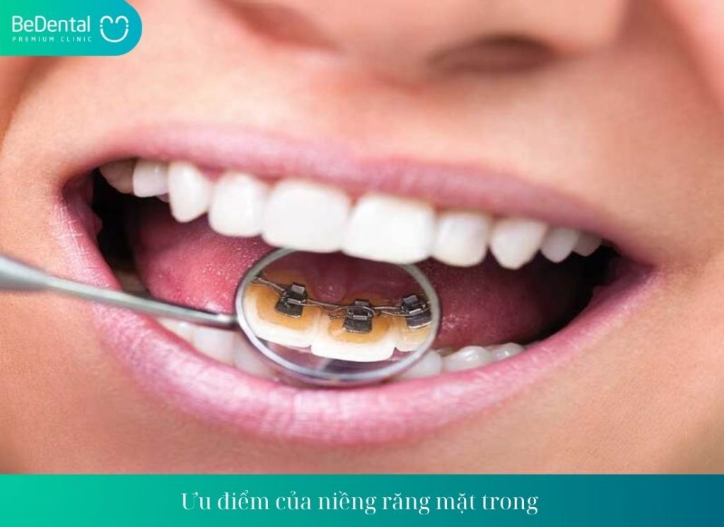 Niềng răng mắc cài mặt trong có hiệu quả không?