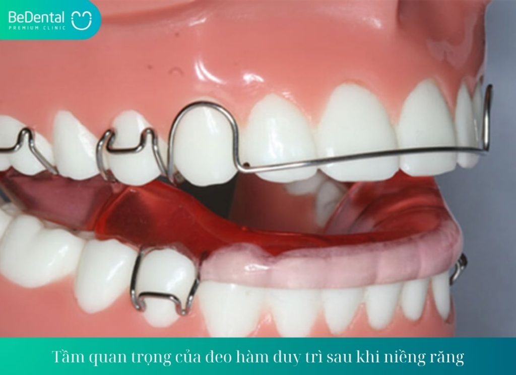 Tầm quan trọng của đeo hàm duy trì sau khi niềng răng