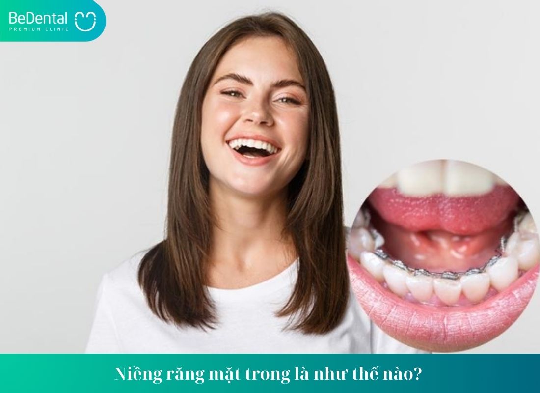 Niềng răng mặt trong là như thế nào? 