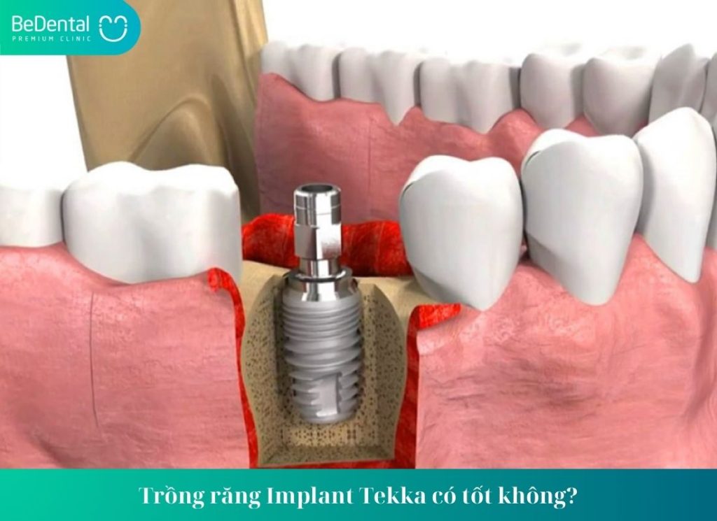 Trồng Răng Implant Tekka Vì Sao Được Ưa Chuộng?