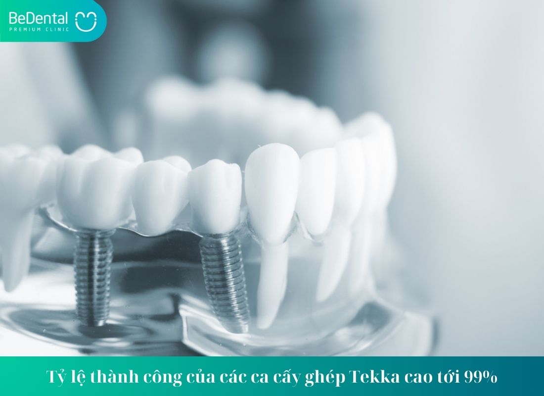 Trồng Răng Implant Tekka Vì Sao Được Ưa Chuộng?