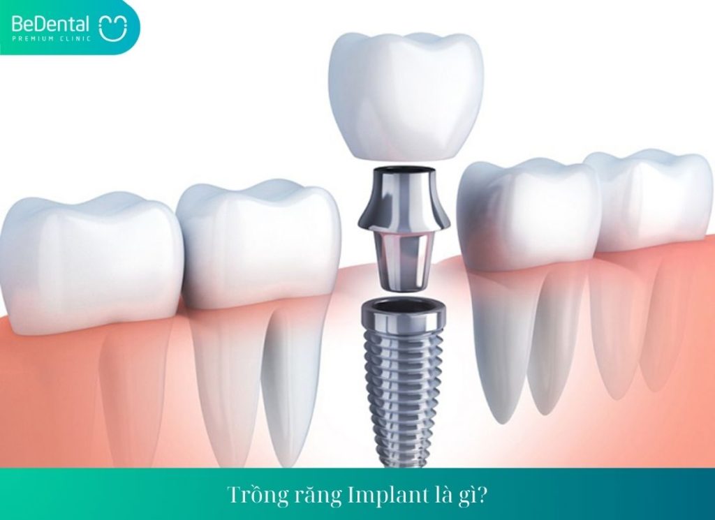 Trồng răng Implant Osstem có hiệu quả không?