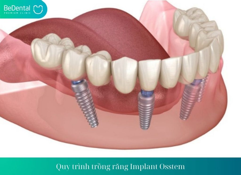 Trồng răng Implant Osstem có hiệu quả không?