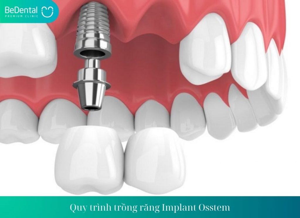 Trồng răng Implant Osstem có hiệu quả không?