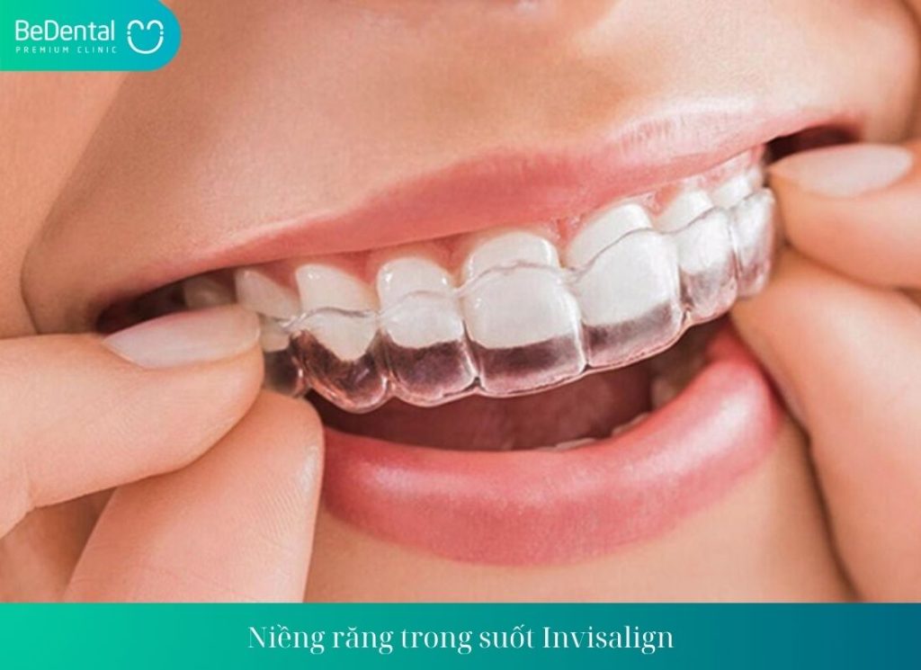 Niềng răng trong suốt Invisalign