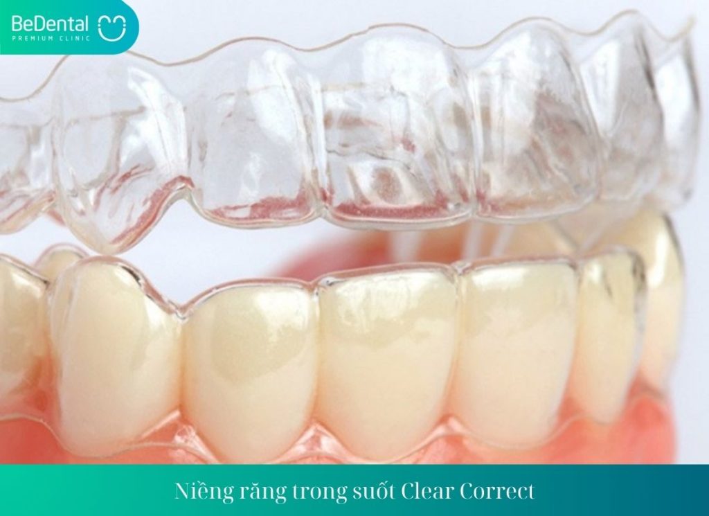 Niềng răng trong suốt Clear Correct