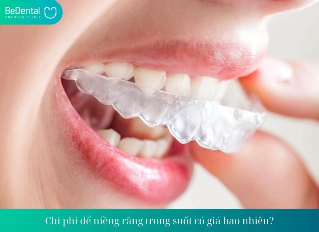 Chi phí để niềng răng trong suốt có giá bao nhiêu?