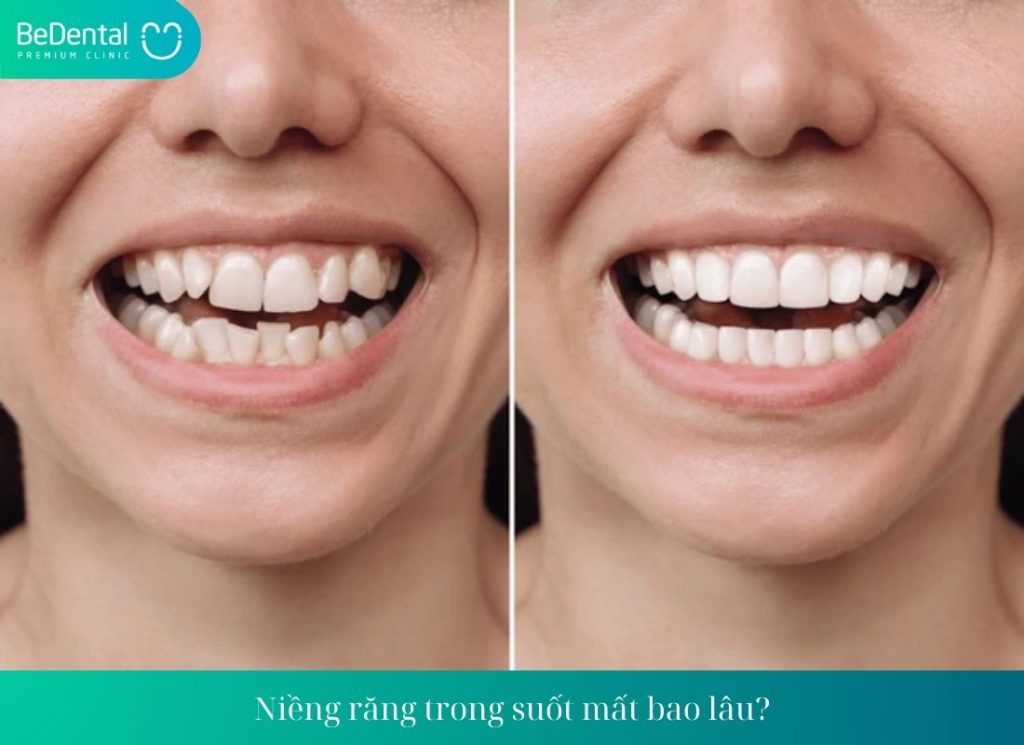 Niềng răng trong suốt mất bao lâu?