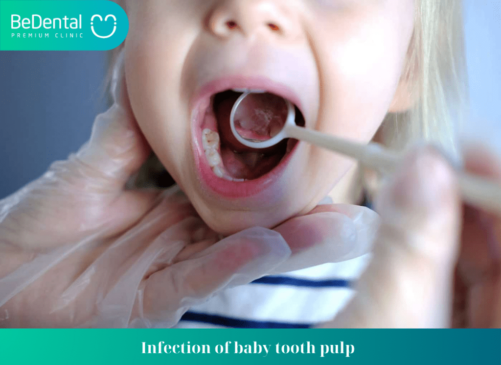 Infection of baby tooth pulp