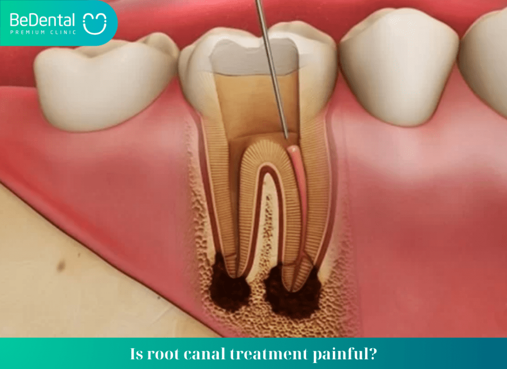 Is root canal treatment painful