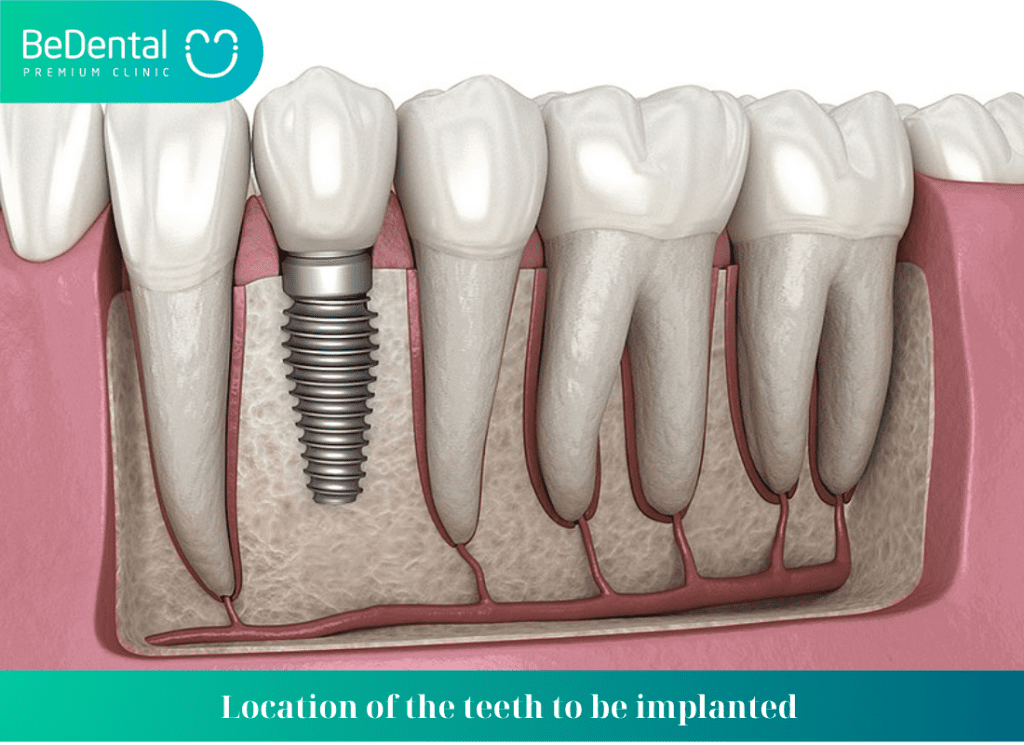 Location of the teeth to be implanted