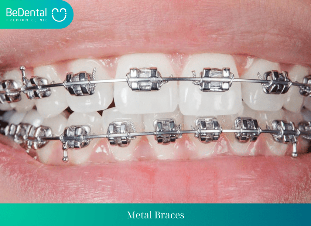 Metal Braces