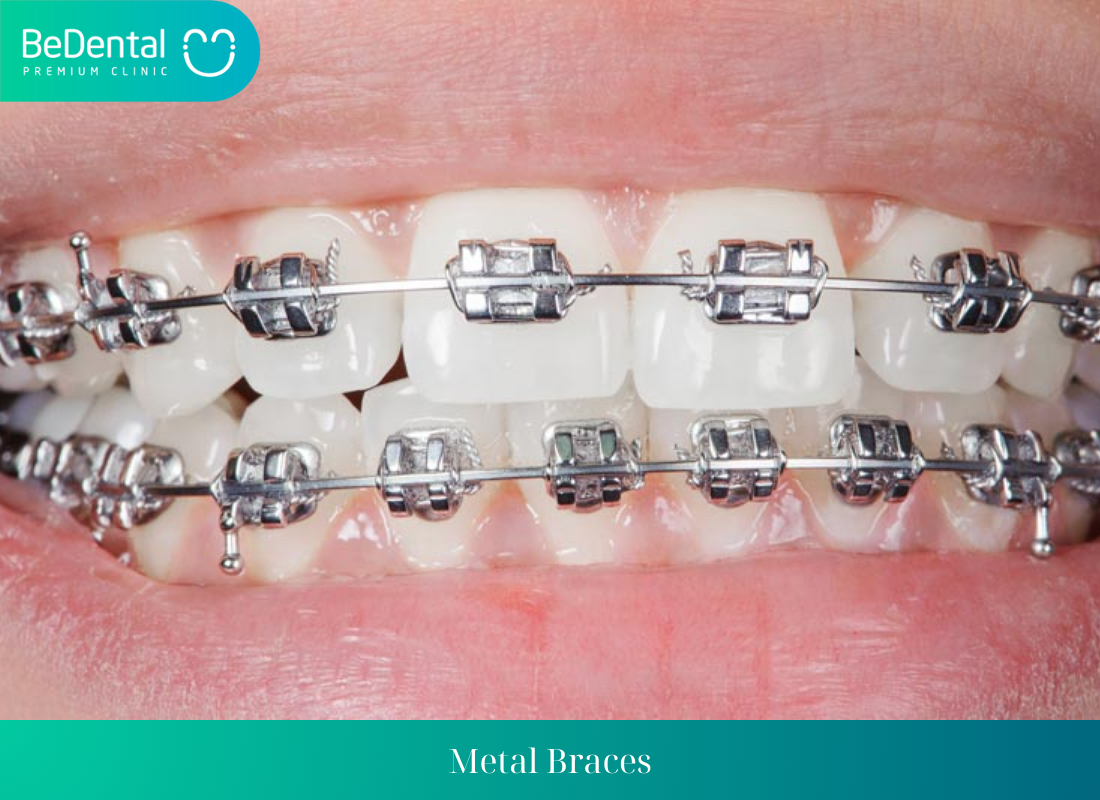 Metal Braces