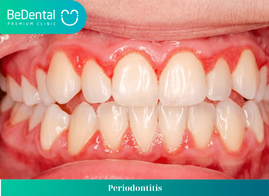 Most common oral diseases