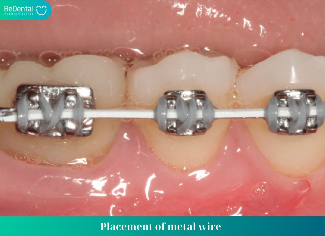 Placement of metal wire