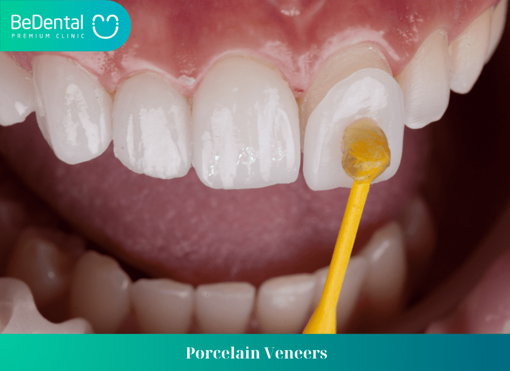 Porcelain Veneers