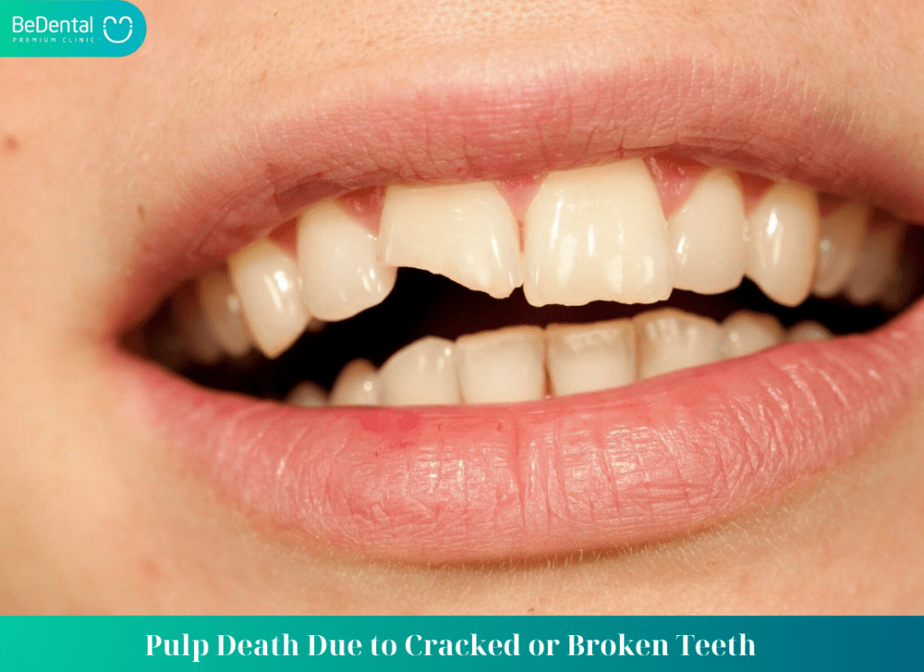 Pulp Death Due to Cracked or Broken Teeth