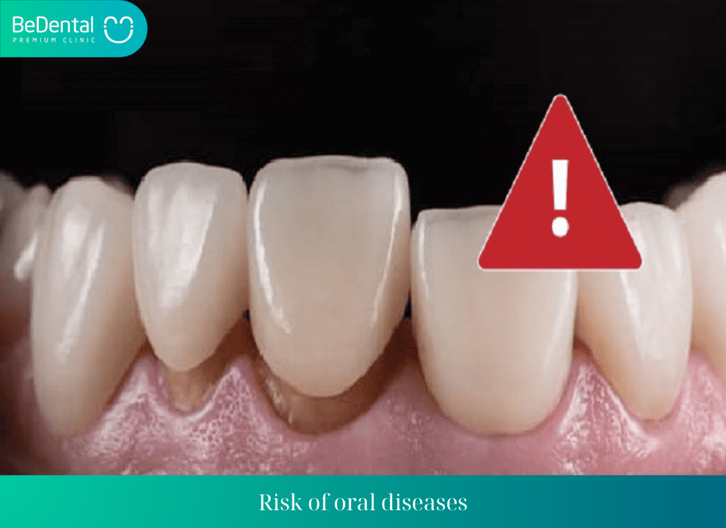 Risk of oral diseases