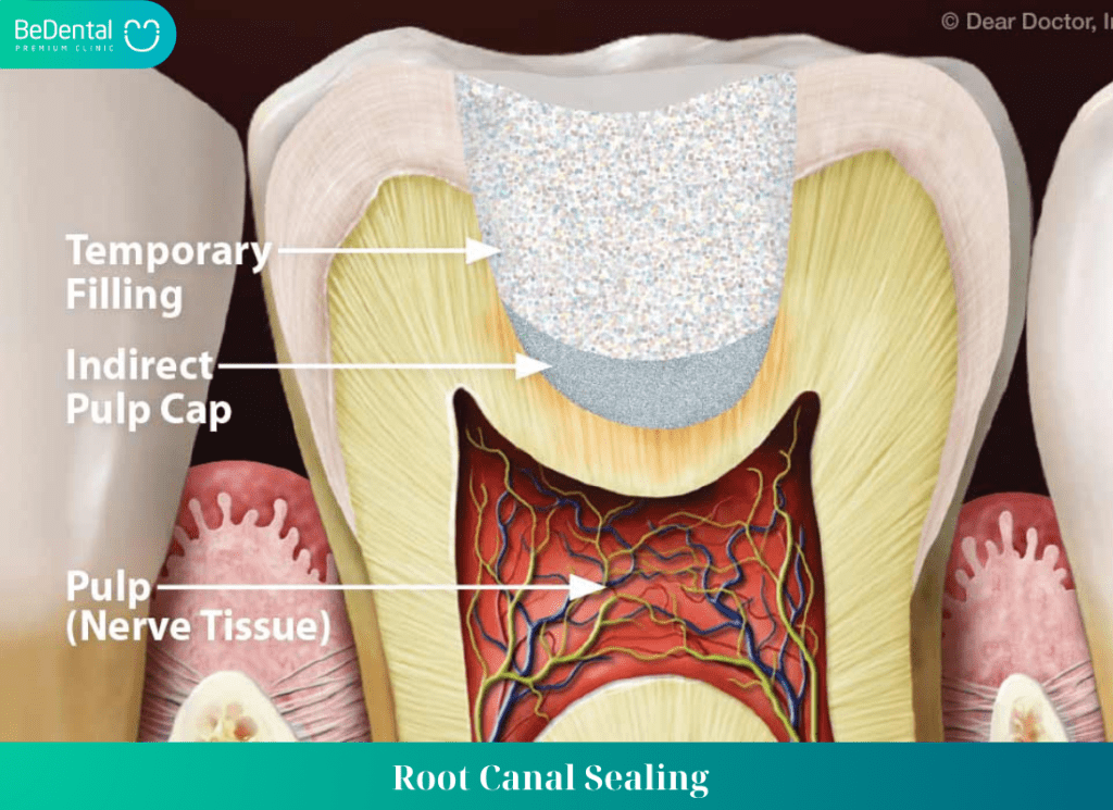 Root Canal Sealing