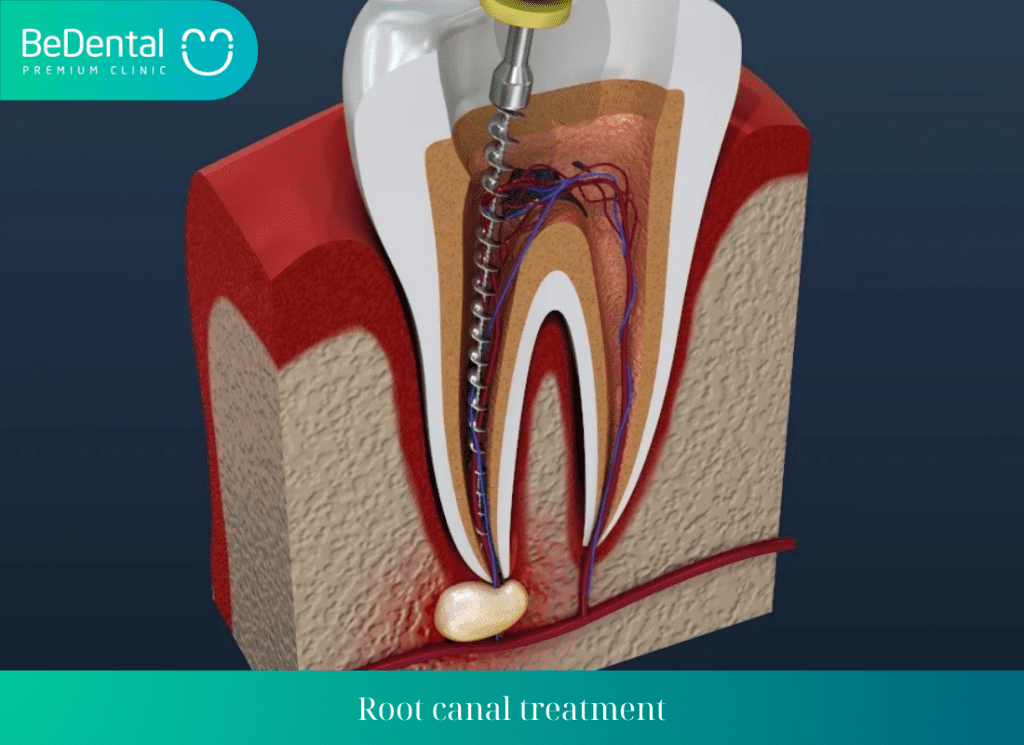 Root canal treatment