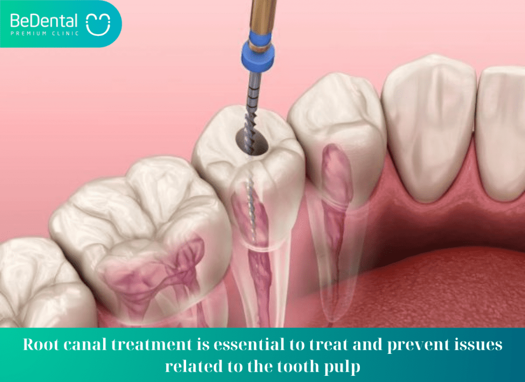 Root canal treatment is essential to treat and prevent issues related to the tooth pulp