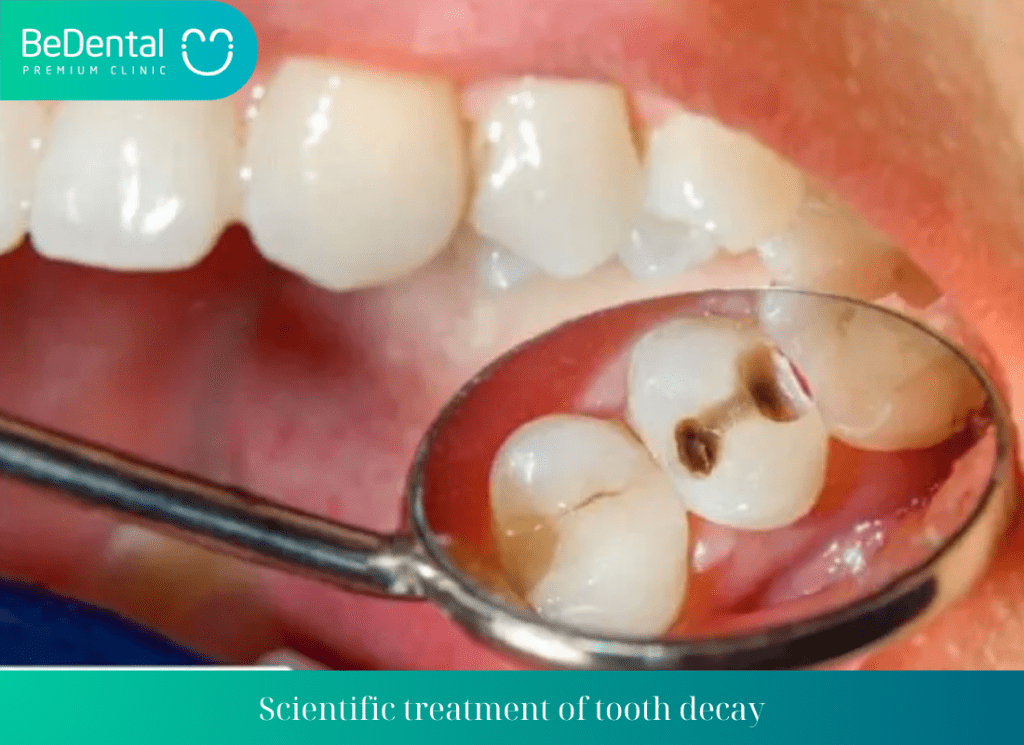 Scientific treatment of tooth decay